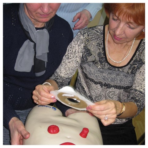 стомированные люди, стома, калоприемник